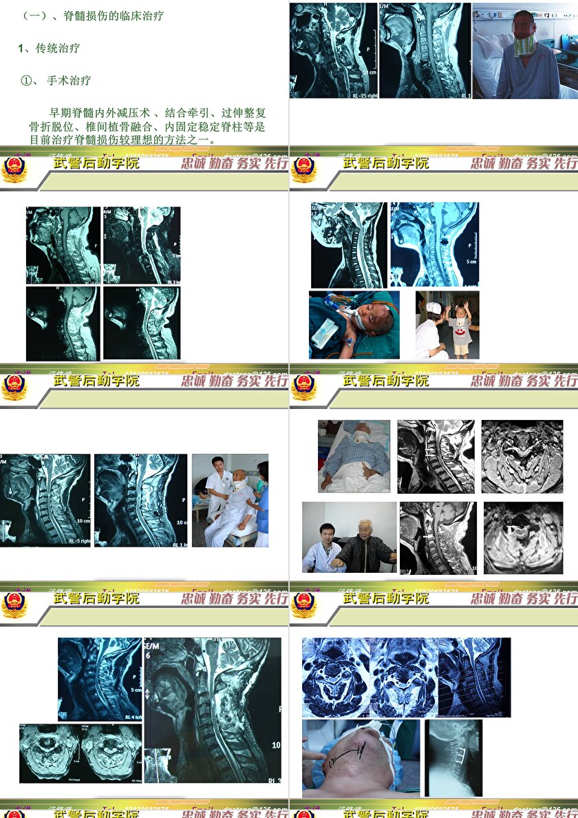 2023年脊髓損傷研究新進(jìn)展，里程碑式的突破與日常奇妙變化