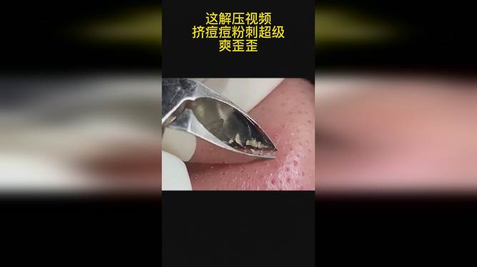 最新擠膿包視頻，見(jiàn)證變化的力量，自信與成就感的誕生之地
